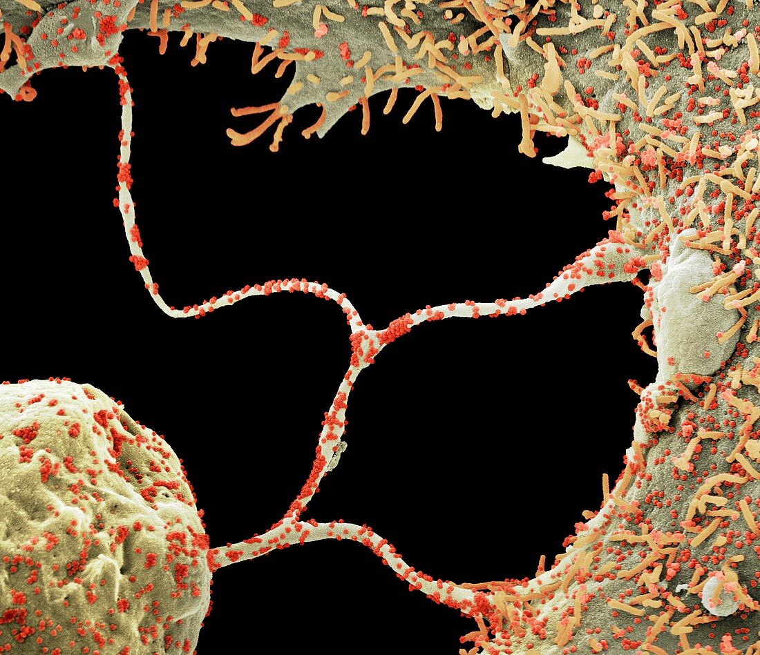Cells infected by Covid-19 virus particles, SEM
