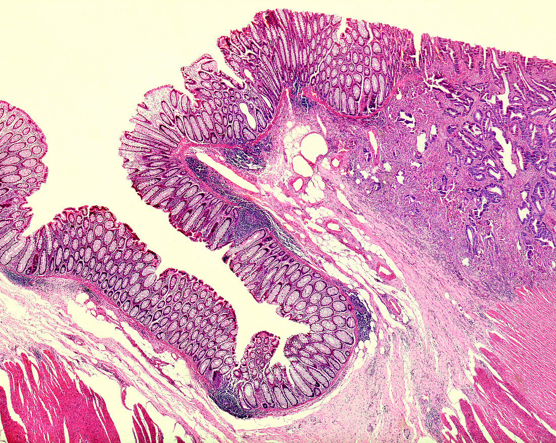 Rectal adenocarcinoma, light micrograph