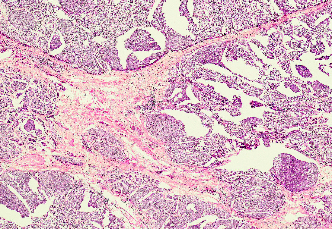 Medullary cancer of the breast, light micrograph