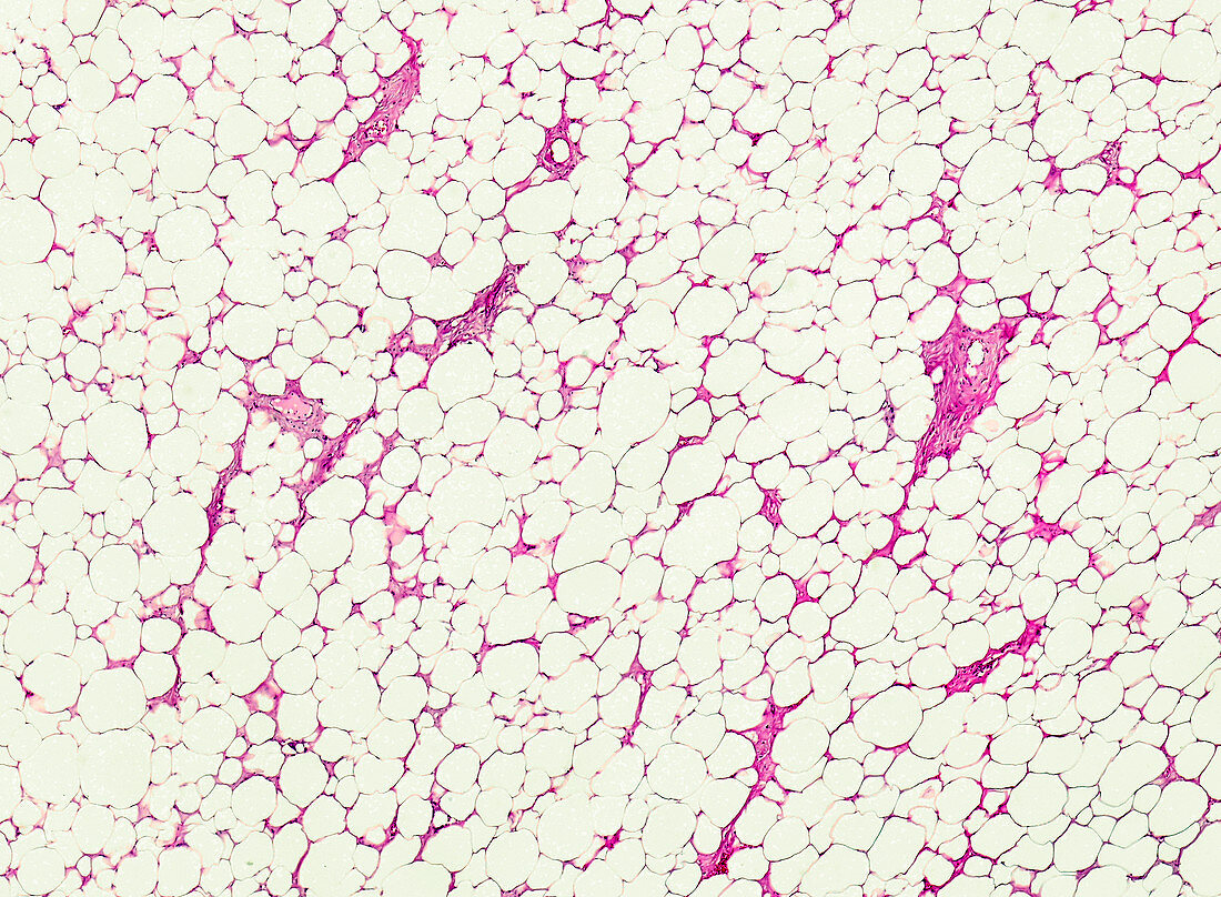 Spindle cell lipoma, light micrograph