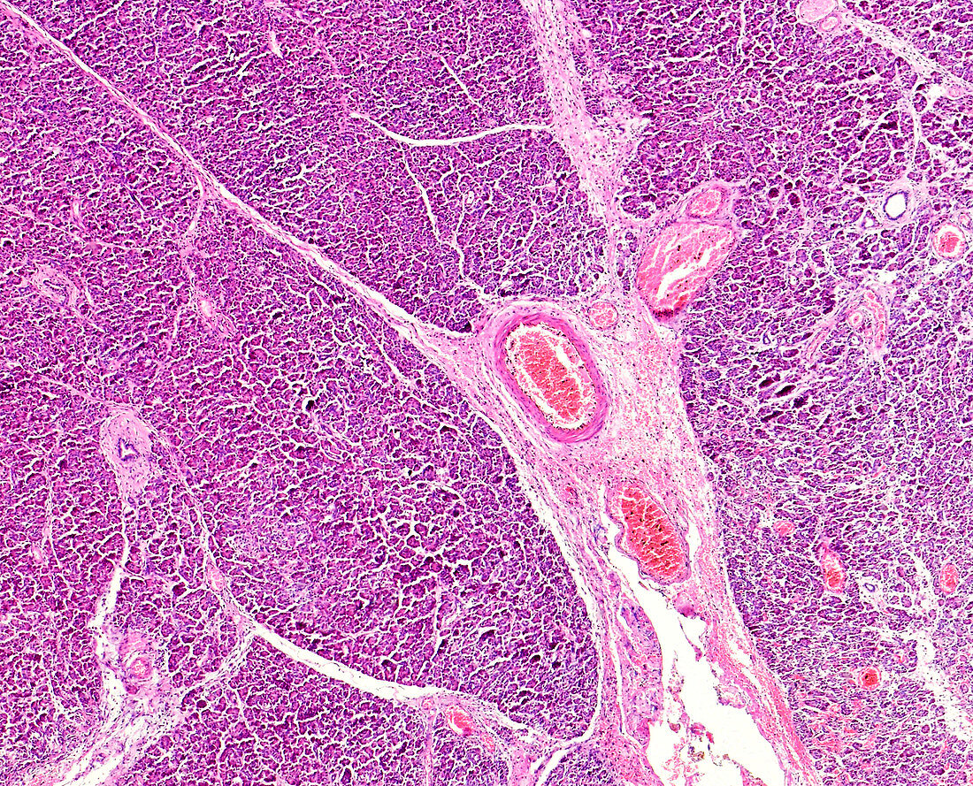 Human necrotising pancreatitis, light micrograph