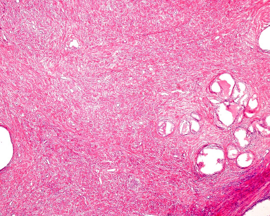 Benign prostatic hyperplasia, light micrograph