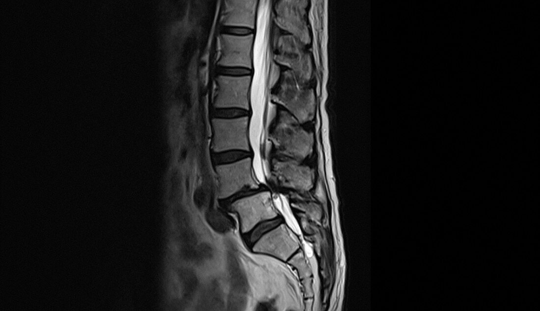 Spinal compression, CT scan