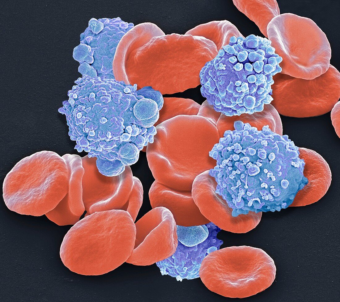 Leukaemia blood cells, SEM