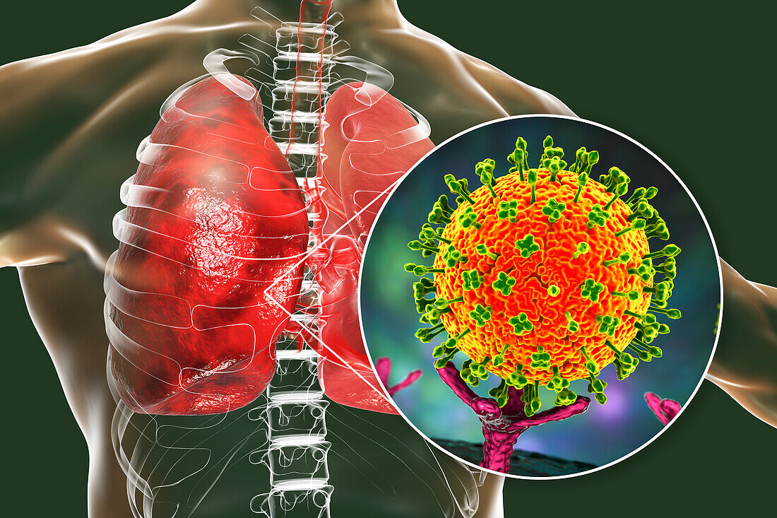 Nipah virus in lungs, illustration
