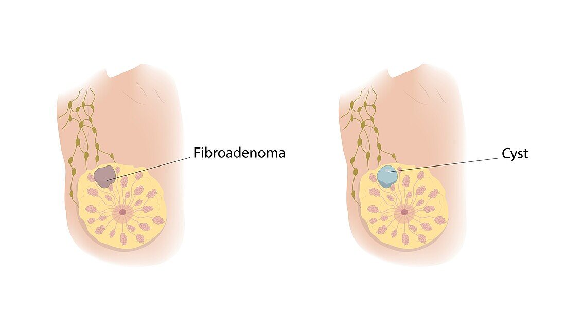 Fibroadenoma and cyst, illustration