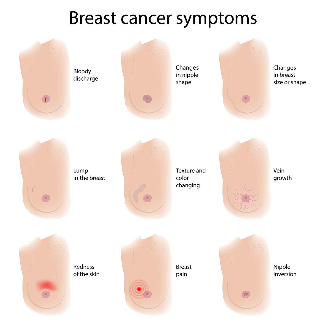 Breast cancer symptoms, illustration