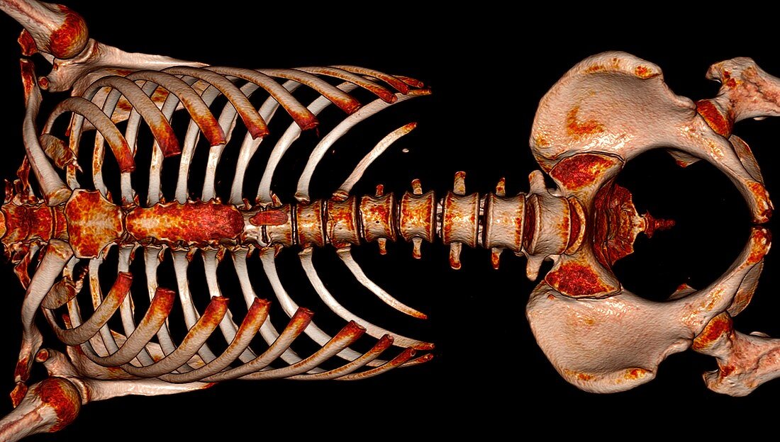 Bones of the torso, 3D CT scan