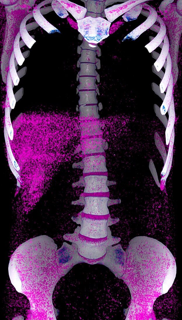 Human torso, 3D CT scan