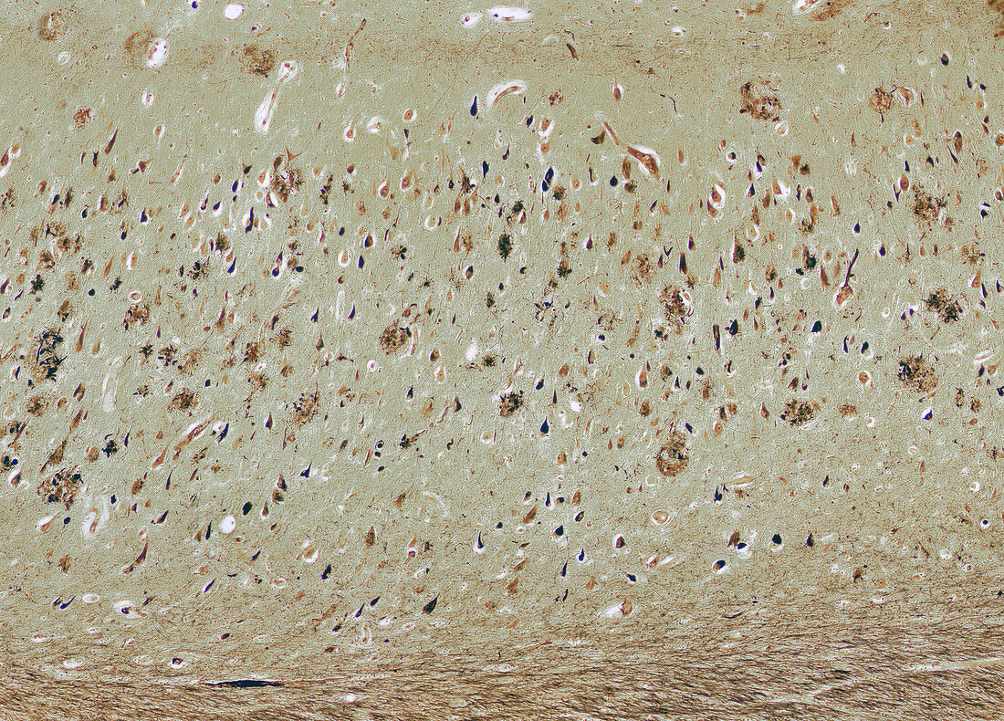 Alzheimer's disease, light micrograph