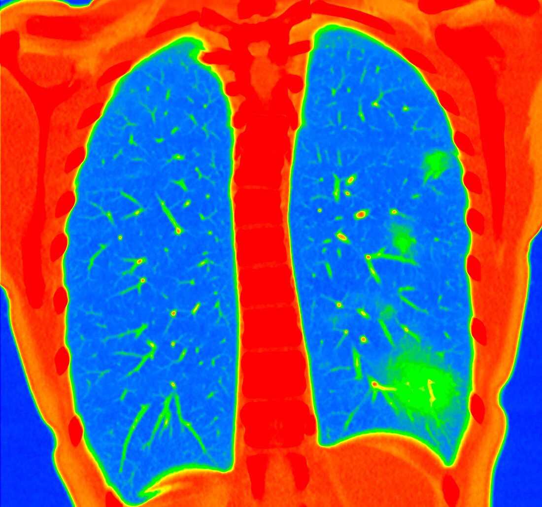 Lungs affected by Covid-19 pneumonia, CT scan