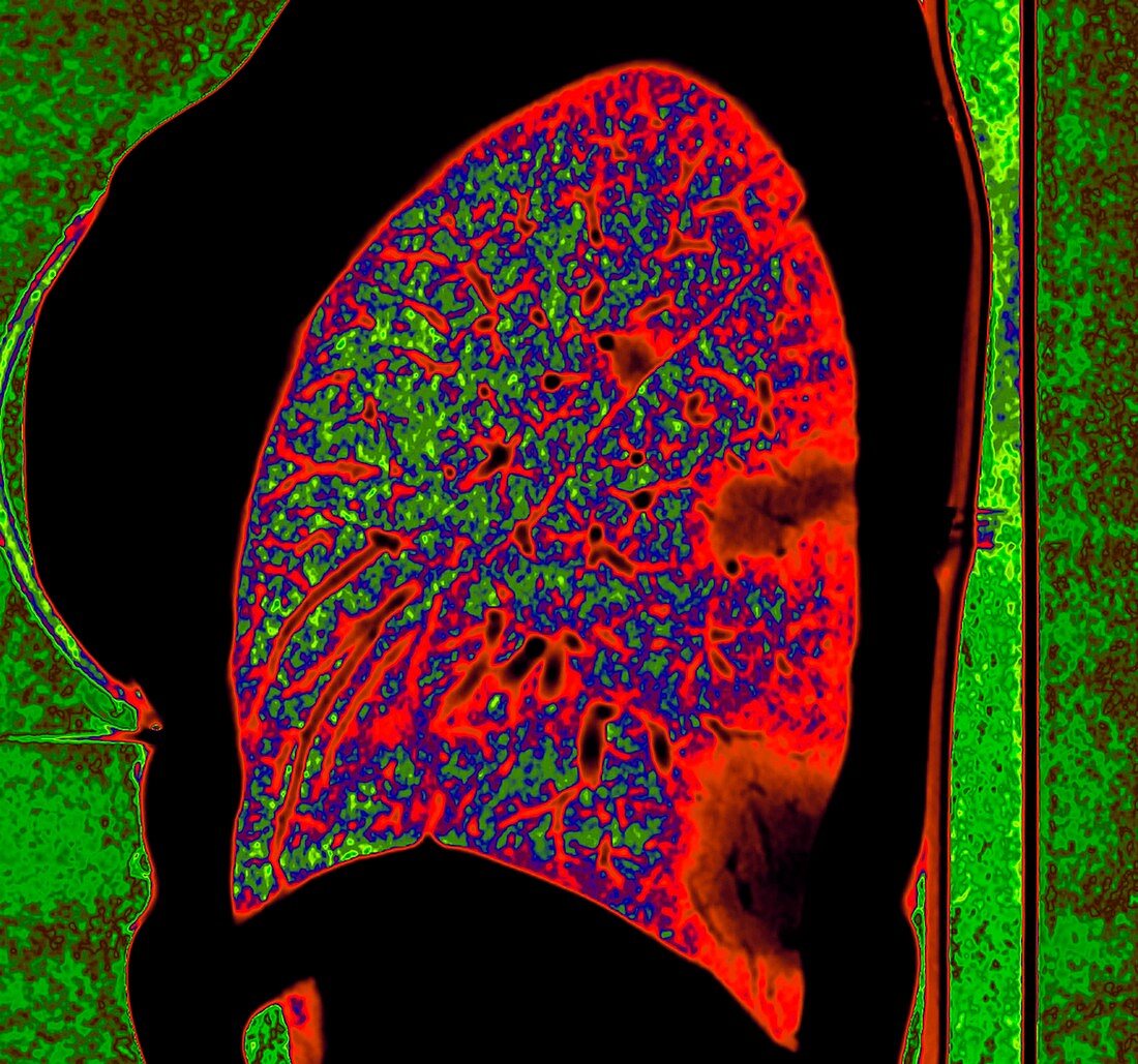 Lung affected by Covid-19 pneumonia, CT scan