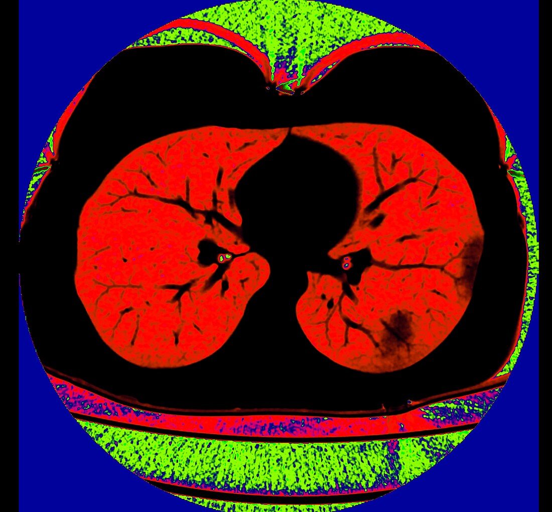 Lungs affected by Covid-19 pneumonia, CT scan