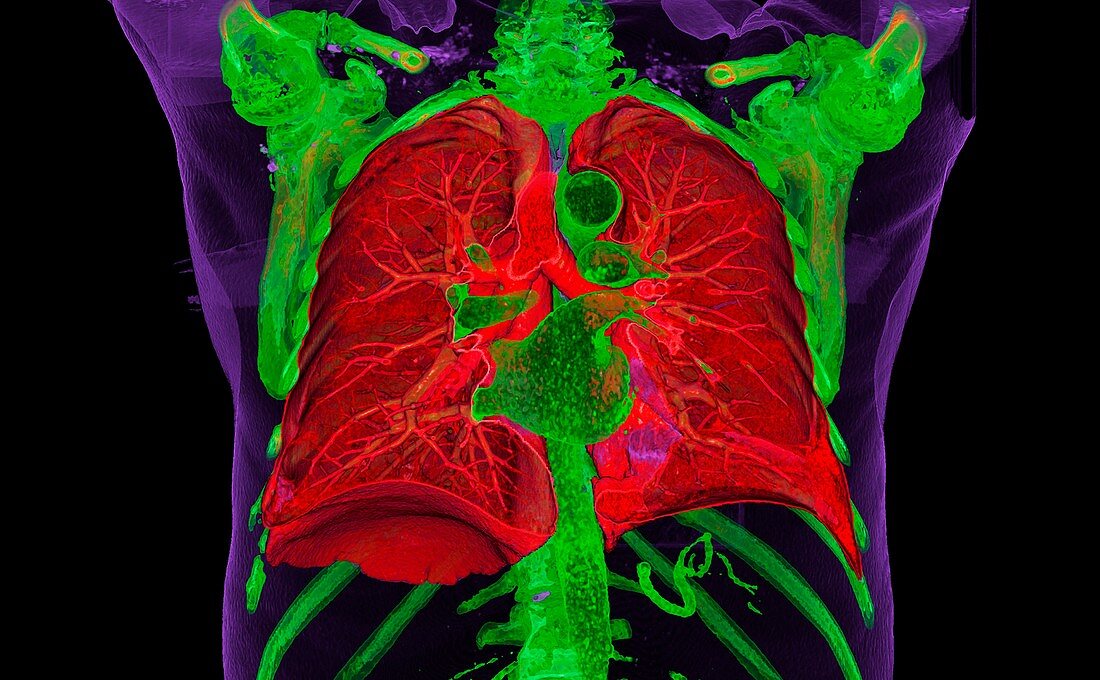 Healthy lungs, 3D CT scan