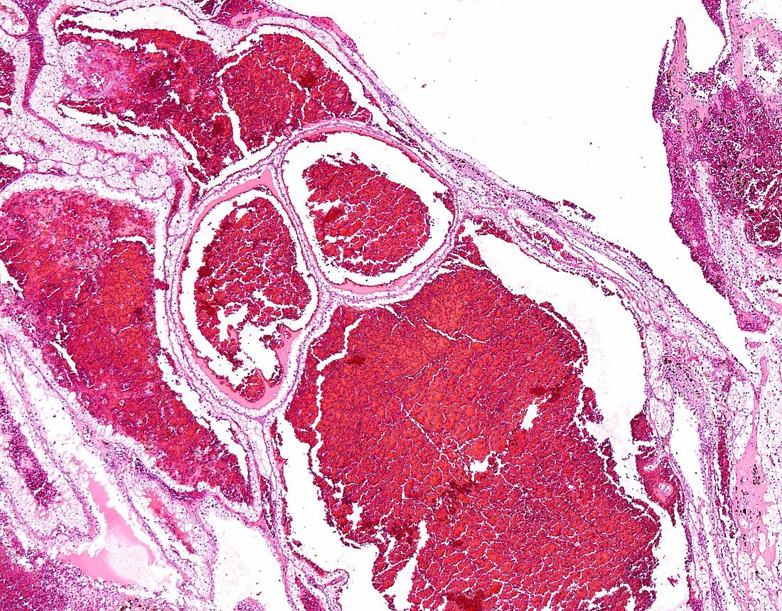Multilocular cystic renal neoplasm, light micrograph