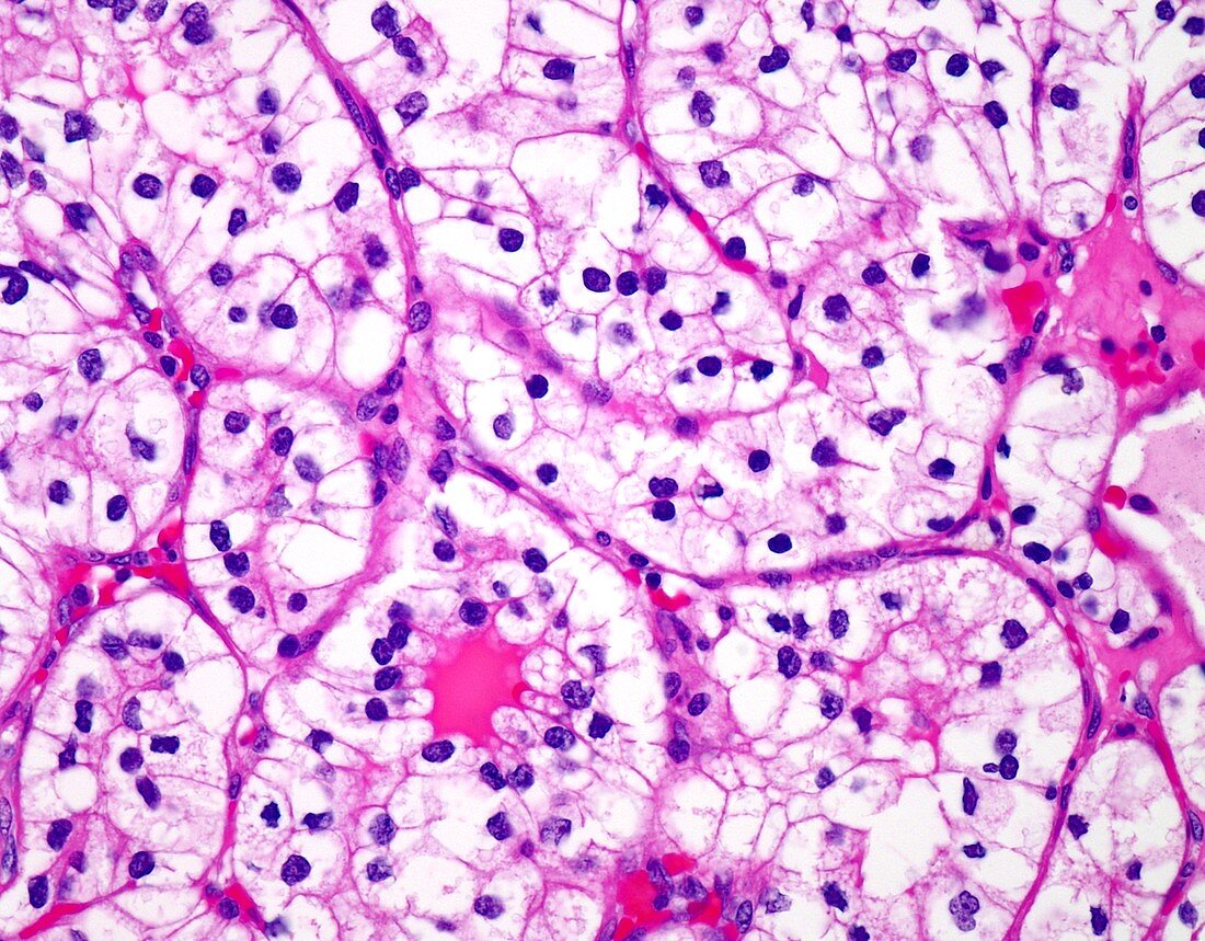 Clear cell renal cell carcinoma, light micrograph