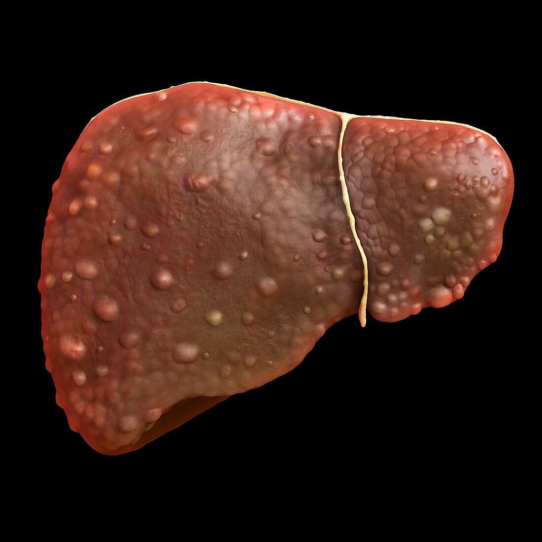 Cirrhotic liver, illustration