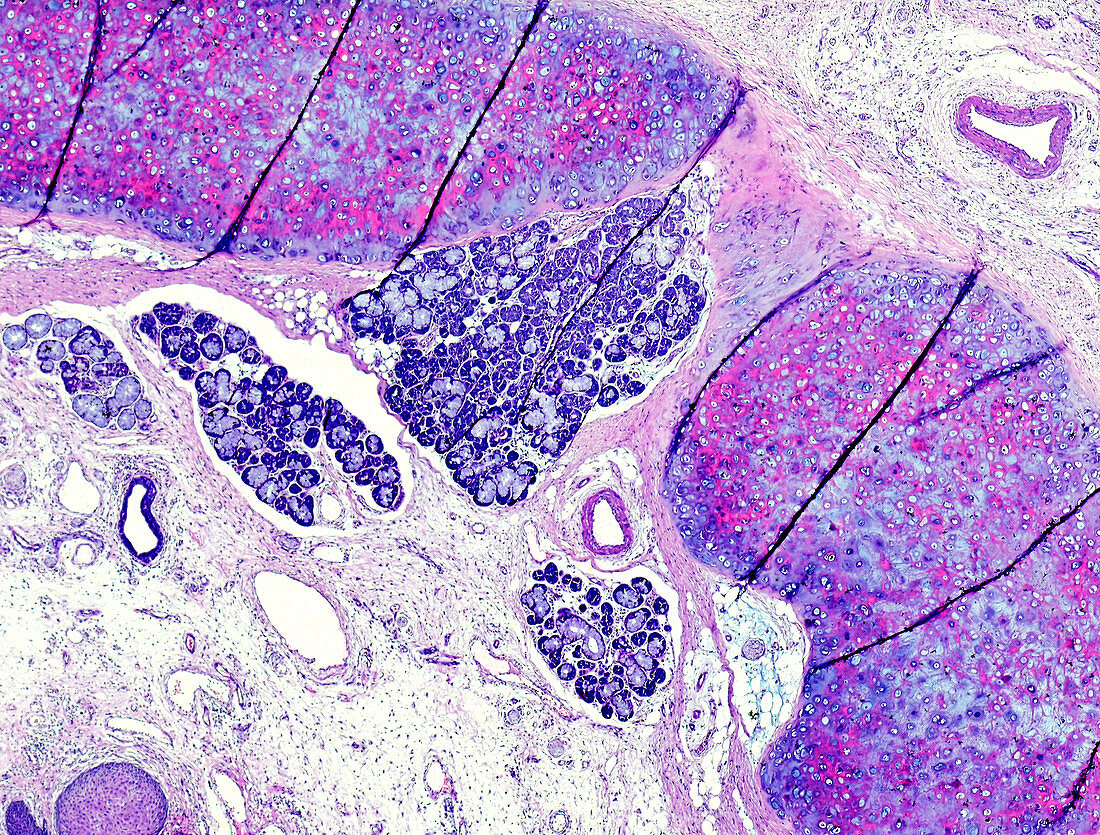 Throat cancer, light micrograph
