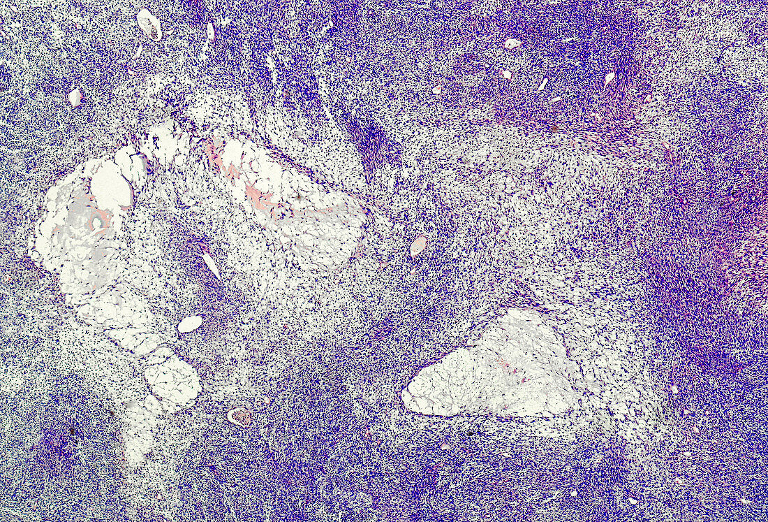 Central nervous system tumour, light micrograph