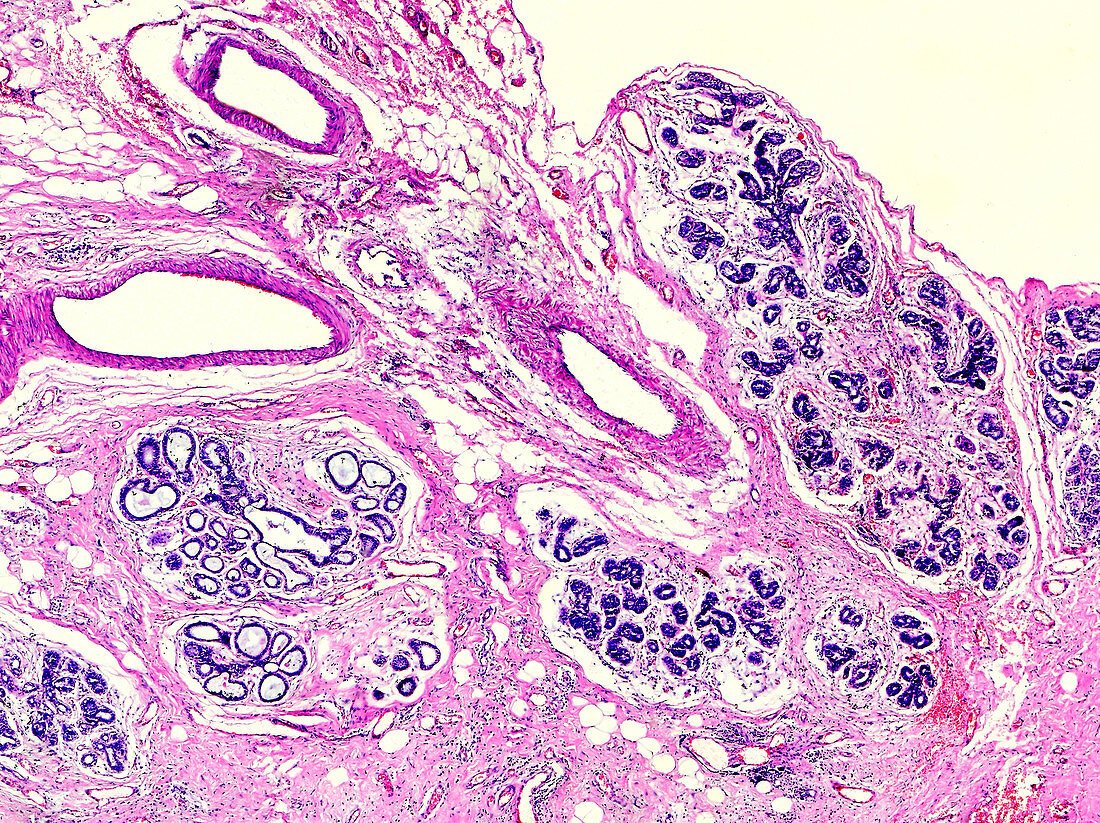 Breast fat necrosis, light micrograph