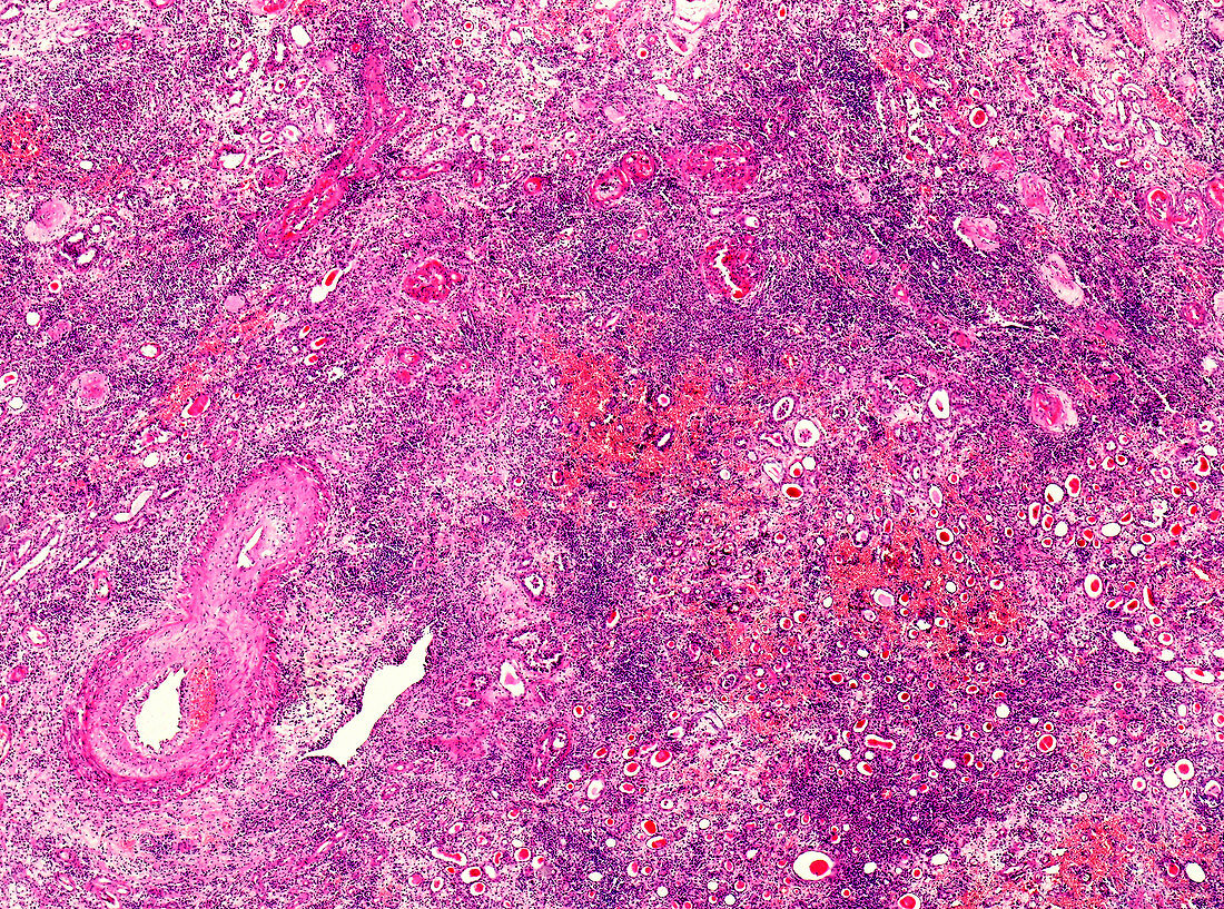 Hypertensive arteriolar nephrosclerosis, light micrograph