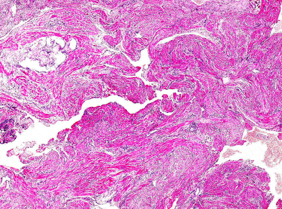 Chorionic carcinoma, light micrograph