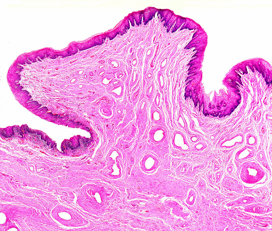 Severe cervical dysplasia, light micrograph