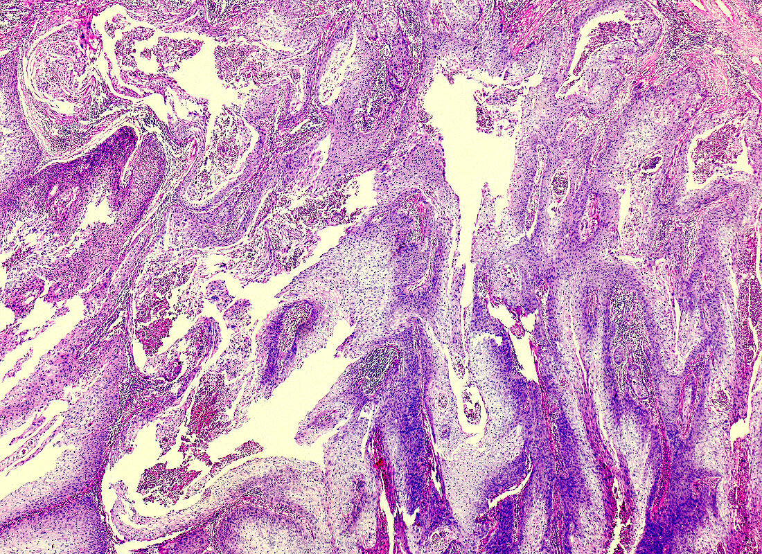 Penile skin cancer, light micrograph