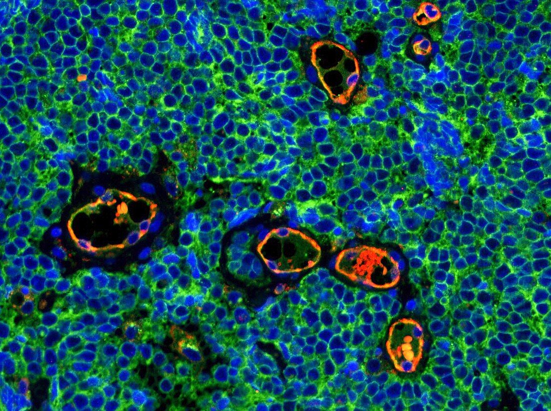 Merkel cell carcinoma, immunofluorescent micrograph