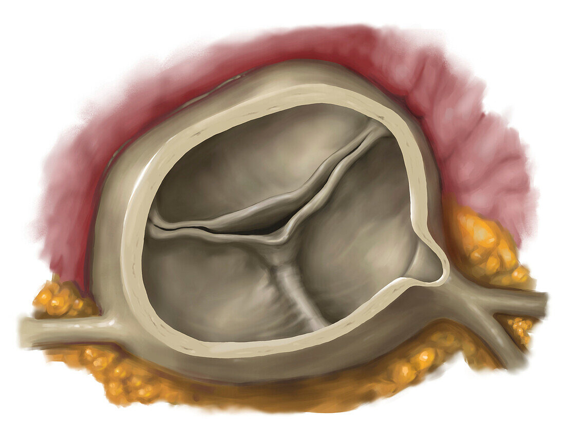 Congenital bicuspid aortic valve, illustration