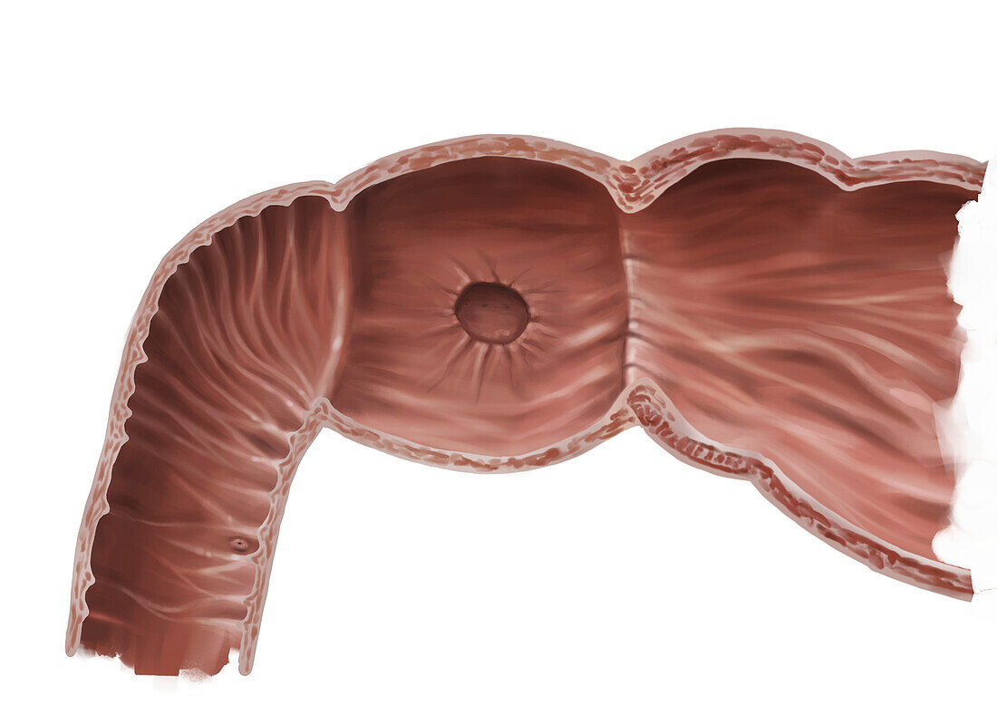 Duodenal ulcer, illustration