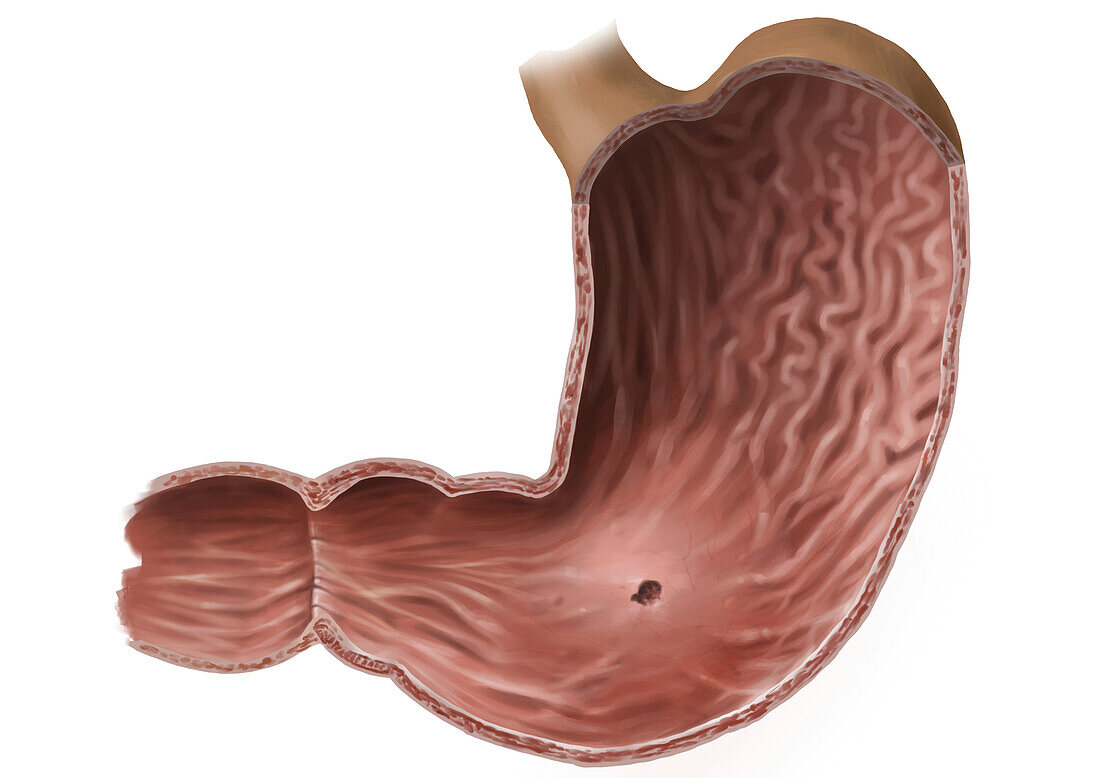 Early stomach cancer, illustration