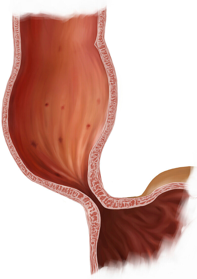 Achalasia of the oesophagus, illustration