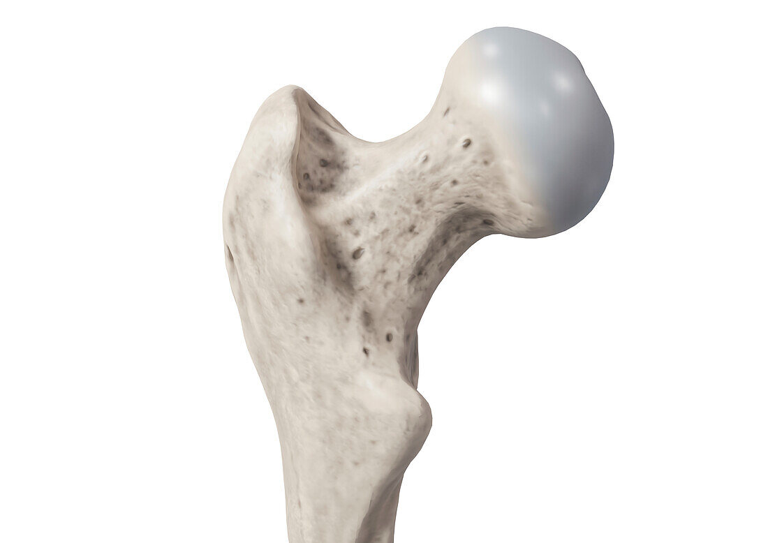 Femoral neck and head, illustration