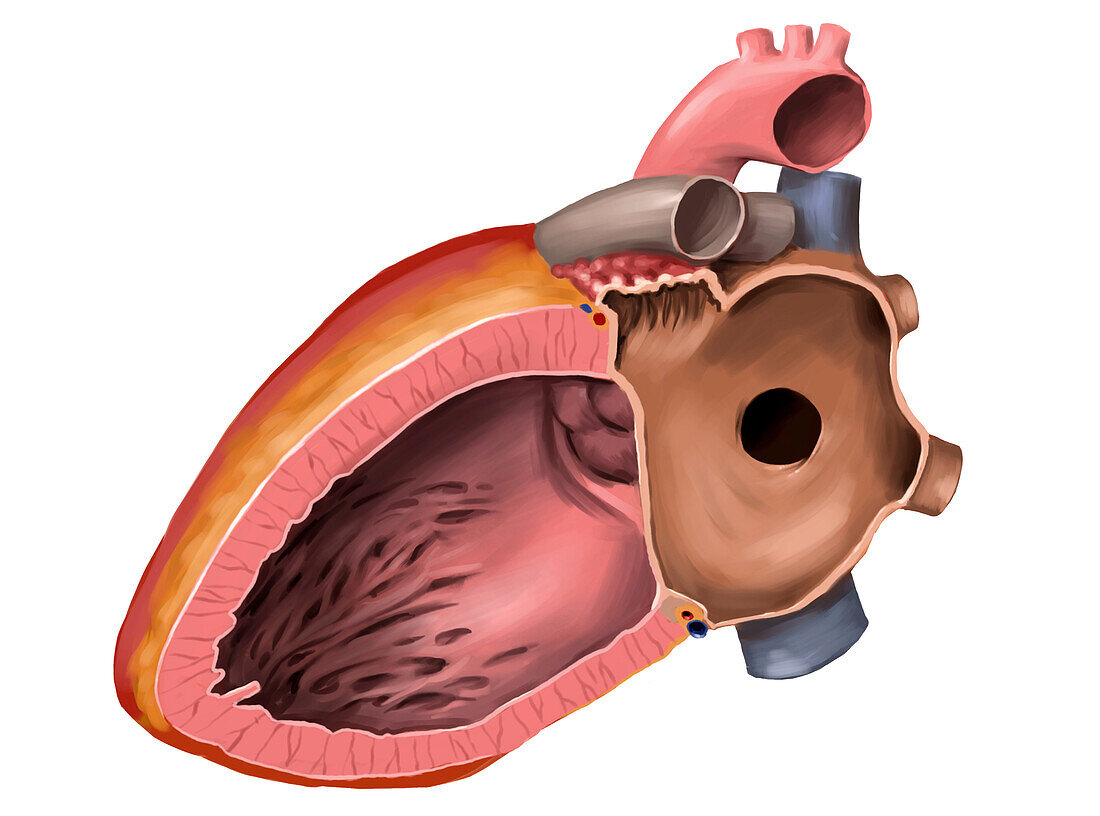 Atrial septal defect, illustration