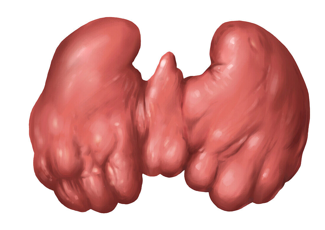 Thyroiditis, illustration