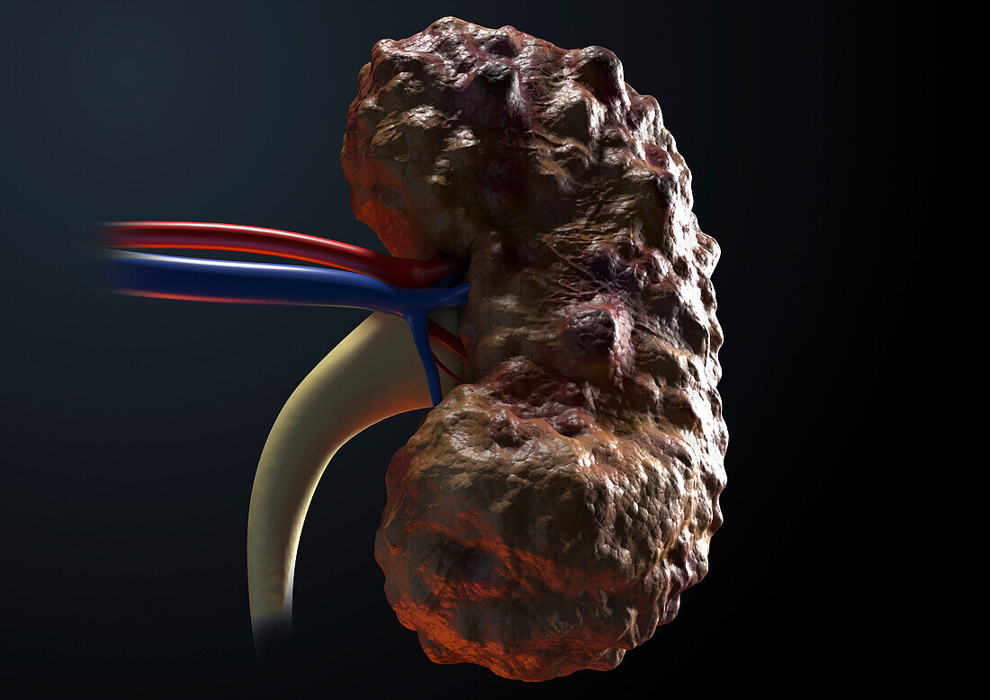 Polycystic kidney disease, illustration