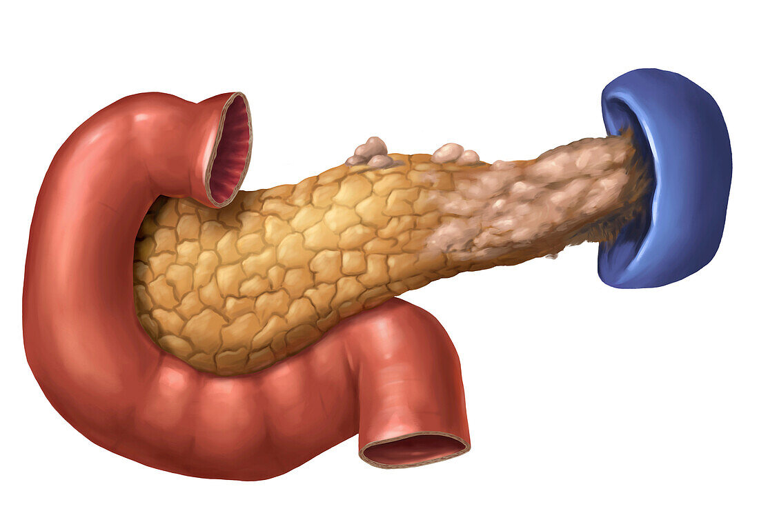 Pancreatic carcinoma, illustration