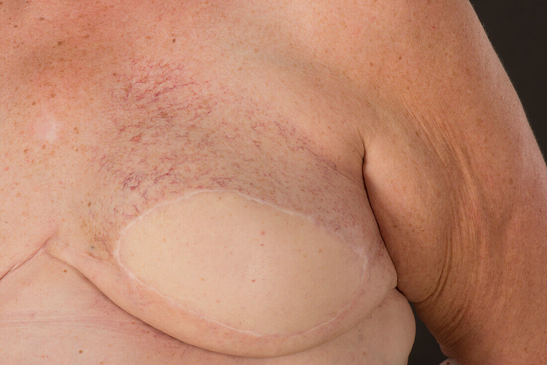 Patient with burns following radiotherapy and spider veins