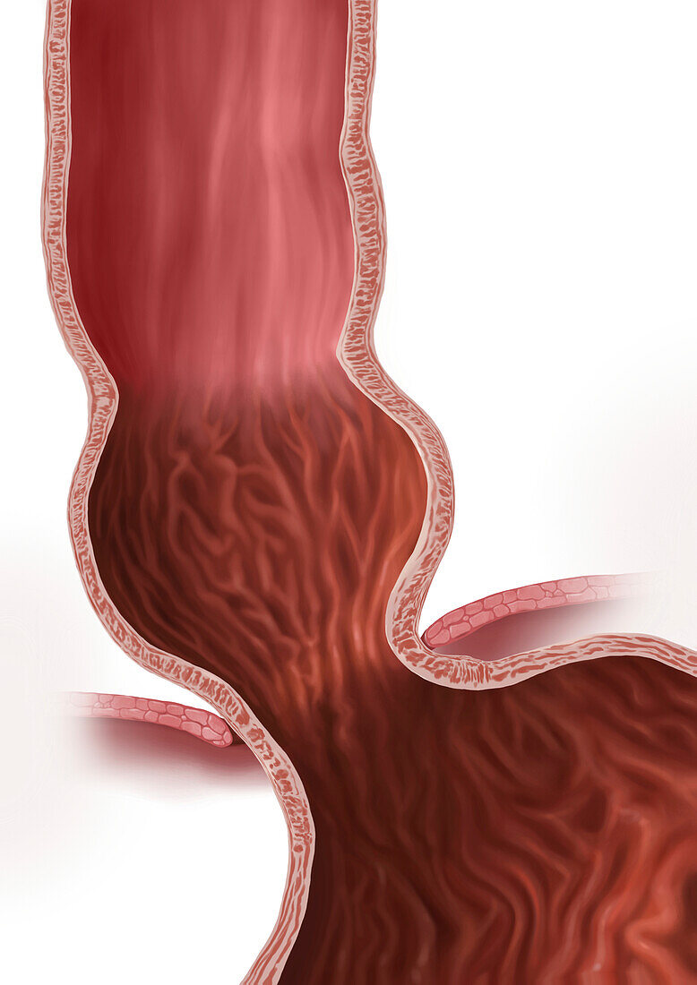 Hiatal hernia, illustration