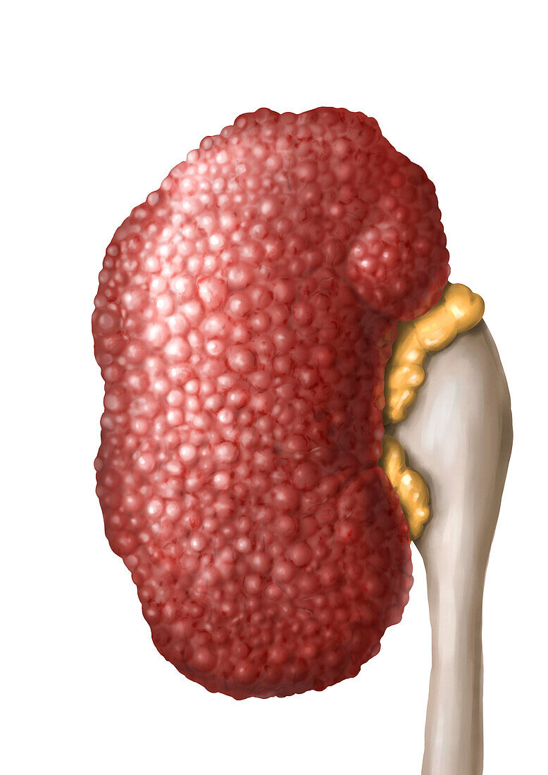 Kidney in chronic hypertension, illustration