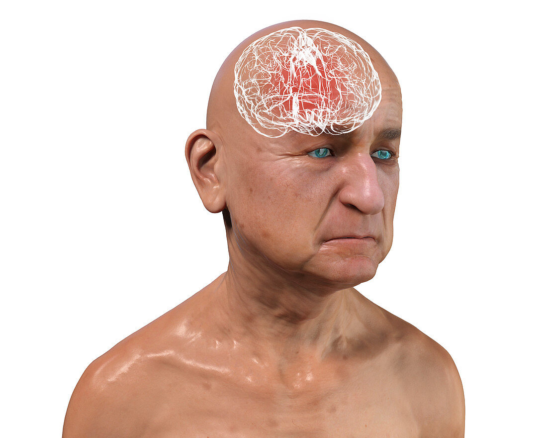 Elderly man's brain in dementia, conceptual illustration