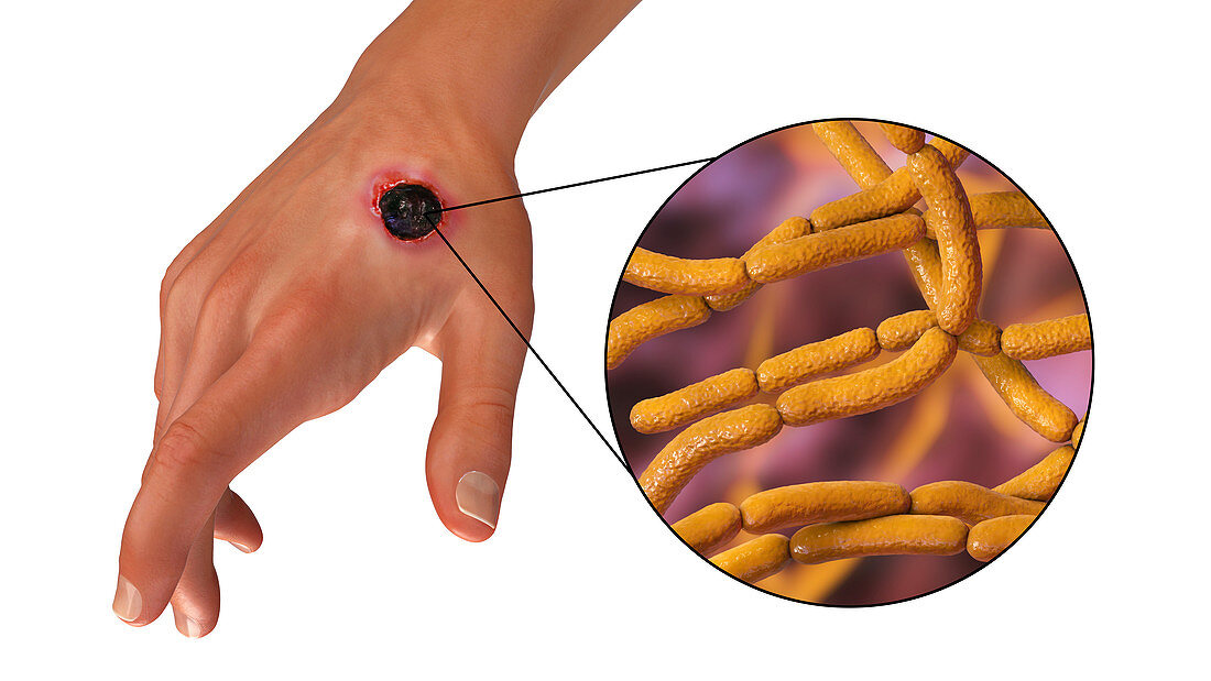 Cutaneous anthrax, illustration