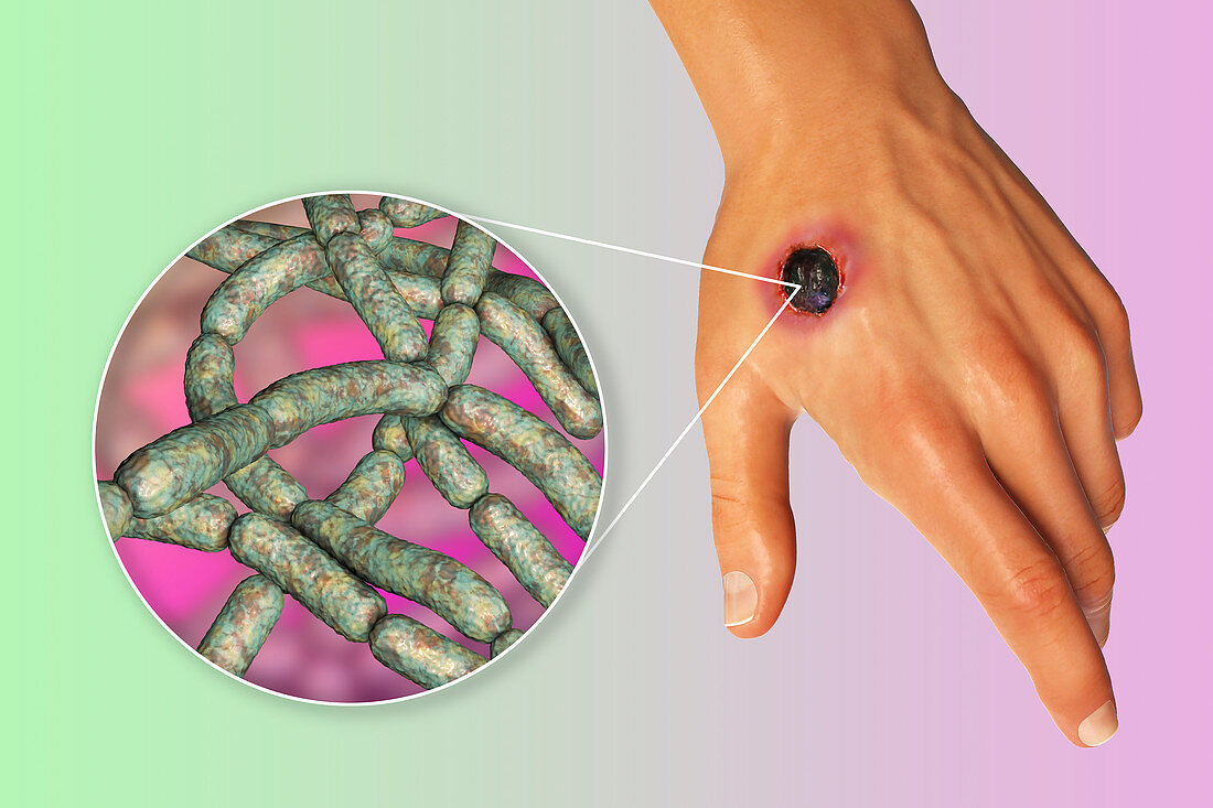 Cutaneous anthrax, illustration