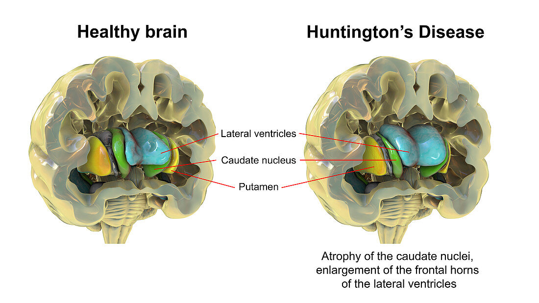 Normal brain and brain in Huntington's disease, illustration