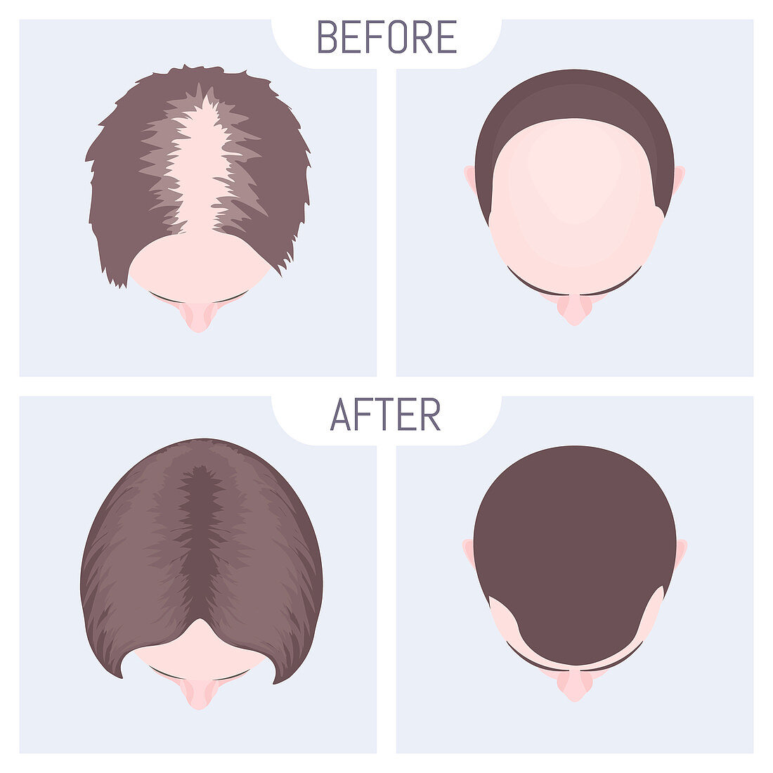 Female and male alopecia treatment, illustration