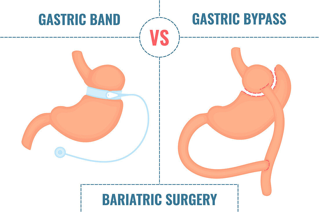 Gastric band vs gastric bypass, illustration