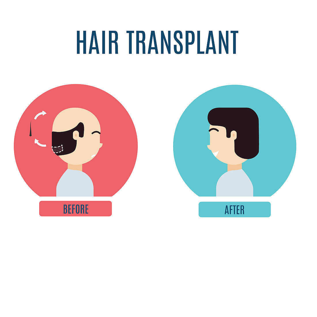 Male hair transplant, illustration
