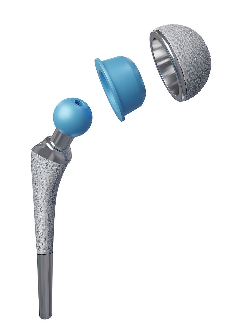 Total hip joint prosthesis, illustration