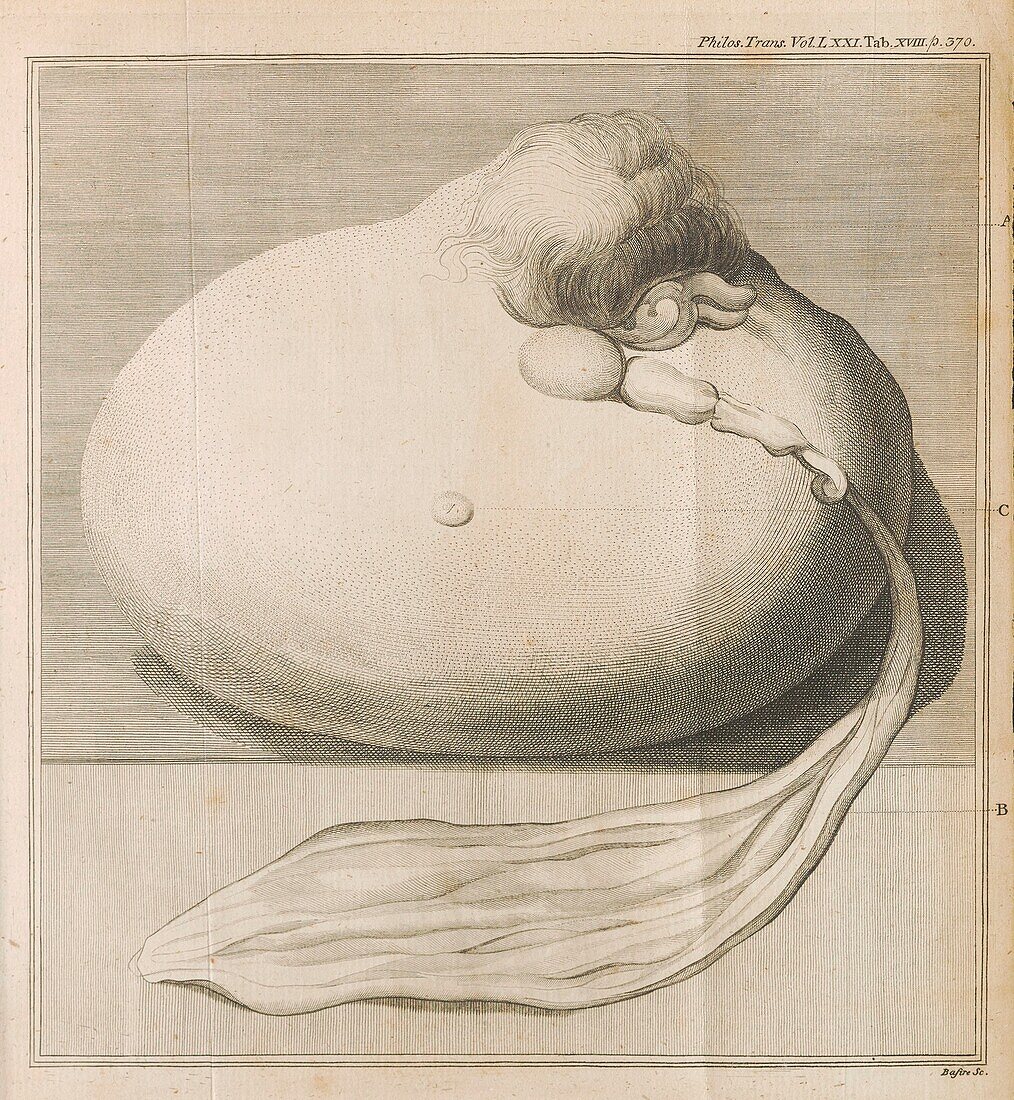 Still birth, 18th century illustration